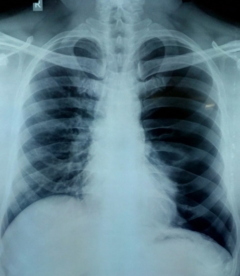 View Of Lung Point A Warning Sign In Pneumothorax Bmh Medical Journal Issn 2348 392x