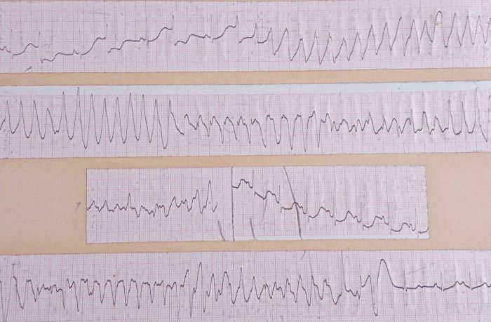 polymorphic ventricular tachycardia vs ventricular fibrillation