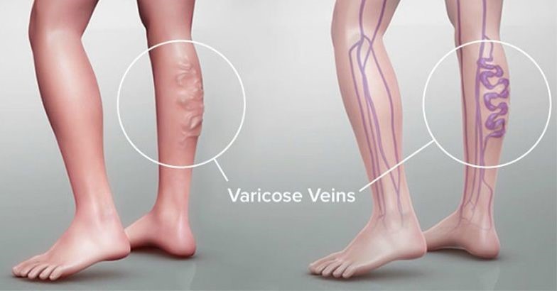 Varicose vein; Diagnosis and Treatment